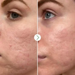 Pai Hyaluronic Acid 0.3% Hydrating booster seerumi 10ml