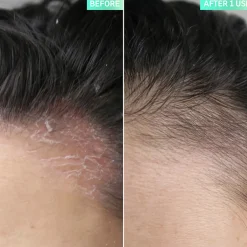 The Inkey List Salicylic Acid Exfoliating Scalp Treatment kuorinta hiuspohjalle 150 ml